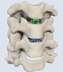 Low cut cervical intervertebral  fusion cage type 1