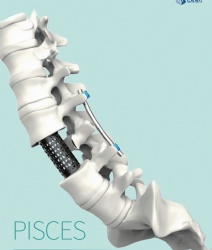 Cervical titanium cage