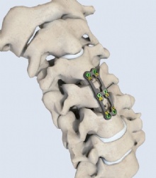 Cervical anterior plate type 2